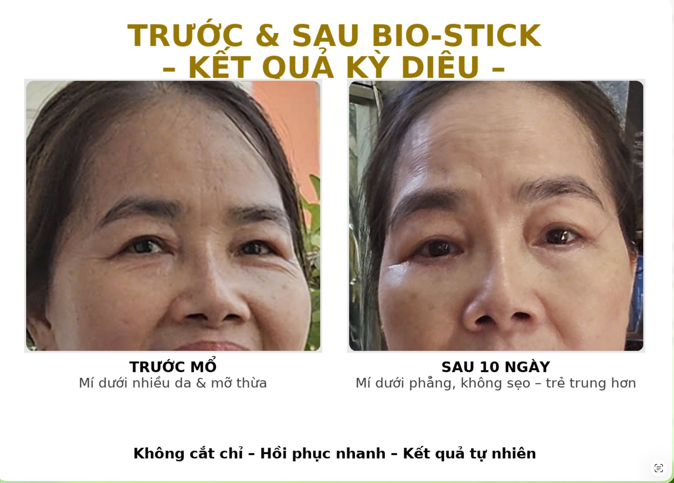 Bio-Stick cắt mí dưới — tiểu thương 52 tuổi trẻ hơn 10 tuổi