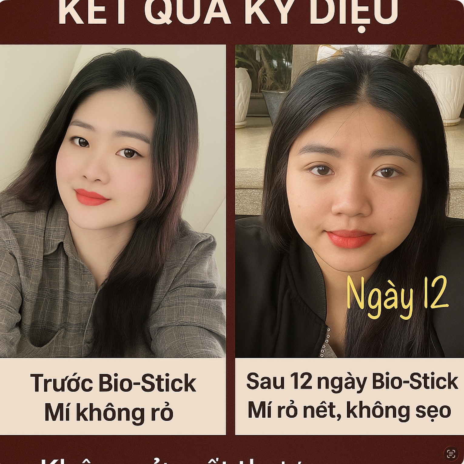 Bio-Stick sửa mí hỏng — cô gái 22 tuổi, kết quả sau 12 ngày