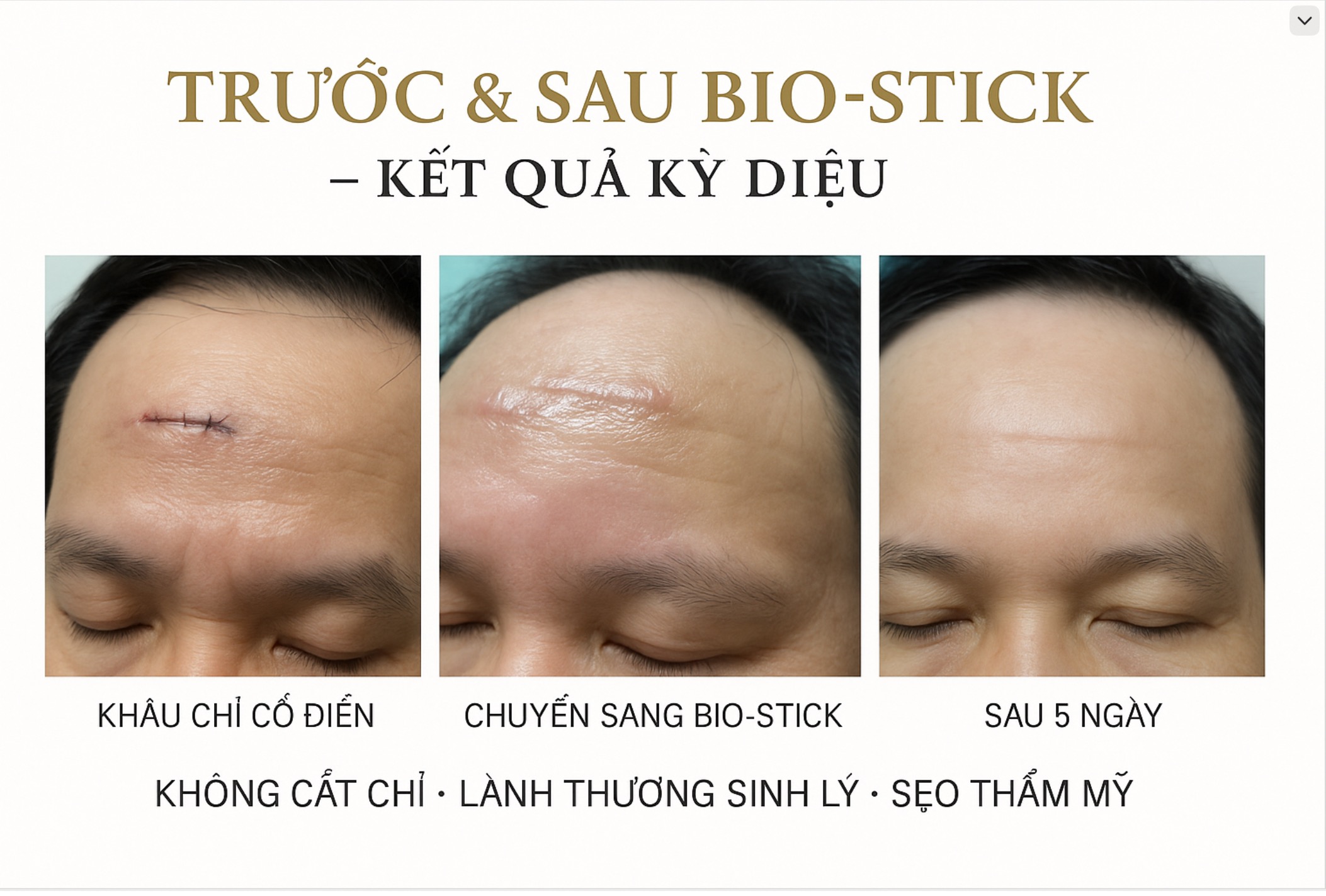 Chuyển từ khâu chỉ cổ điển sang Bio-Stick — sẹo mờ sau 5 ngày, Dr. Phan Sử
