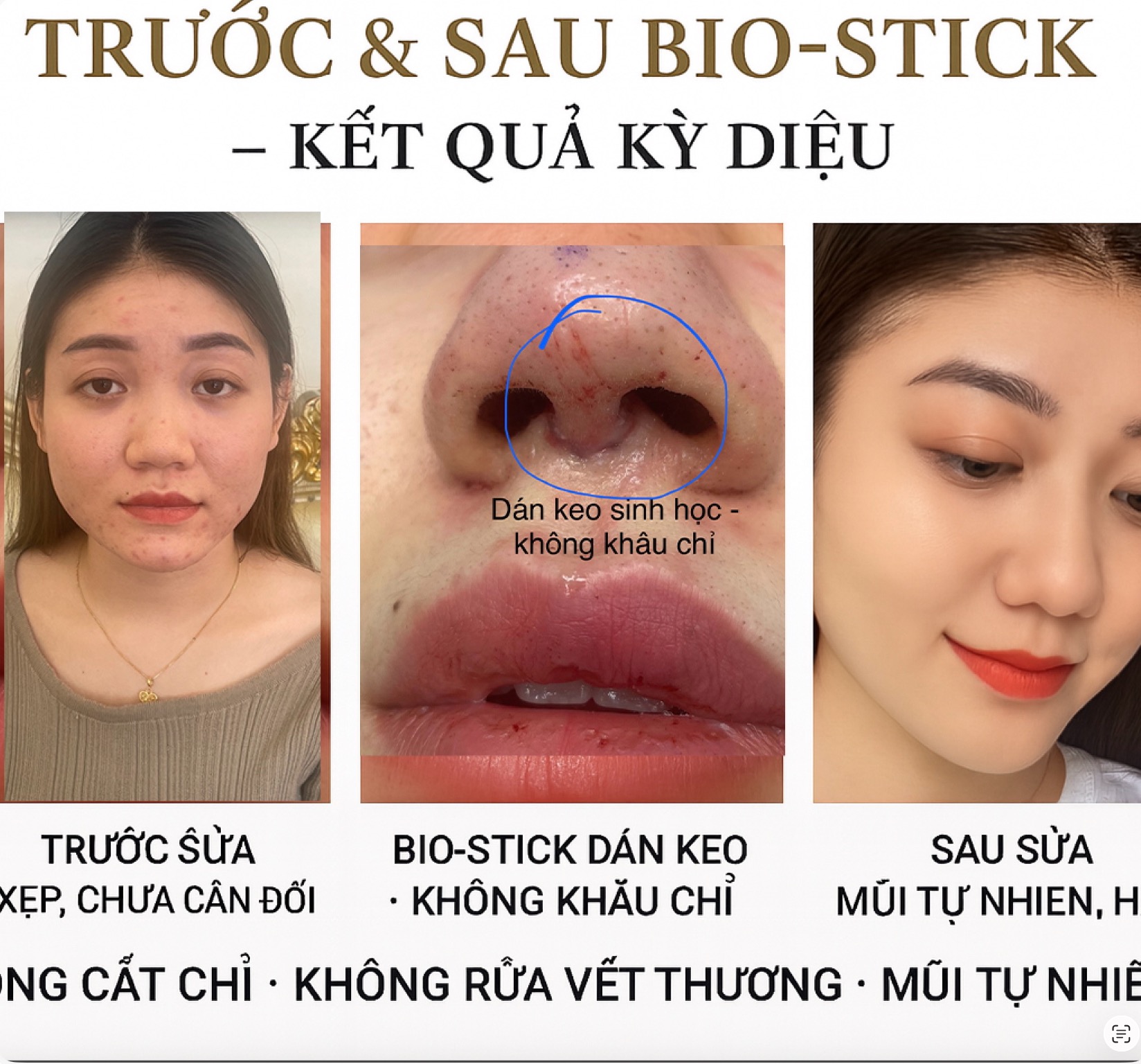 Bio-Stick nâng mũi Việt kiều Malaysia — không sẹo, tự nhiên