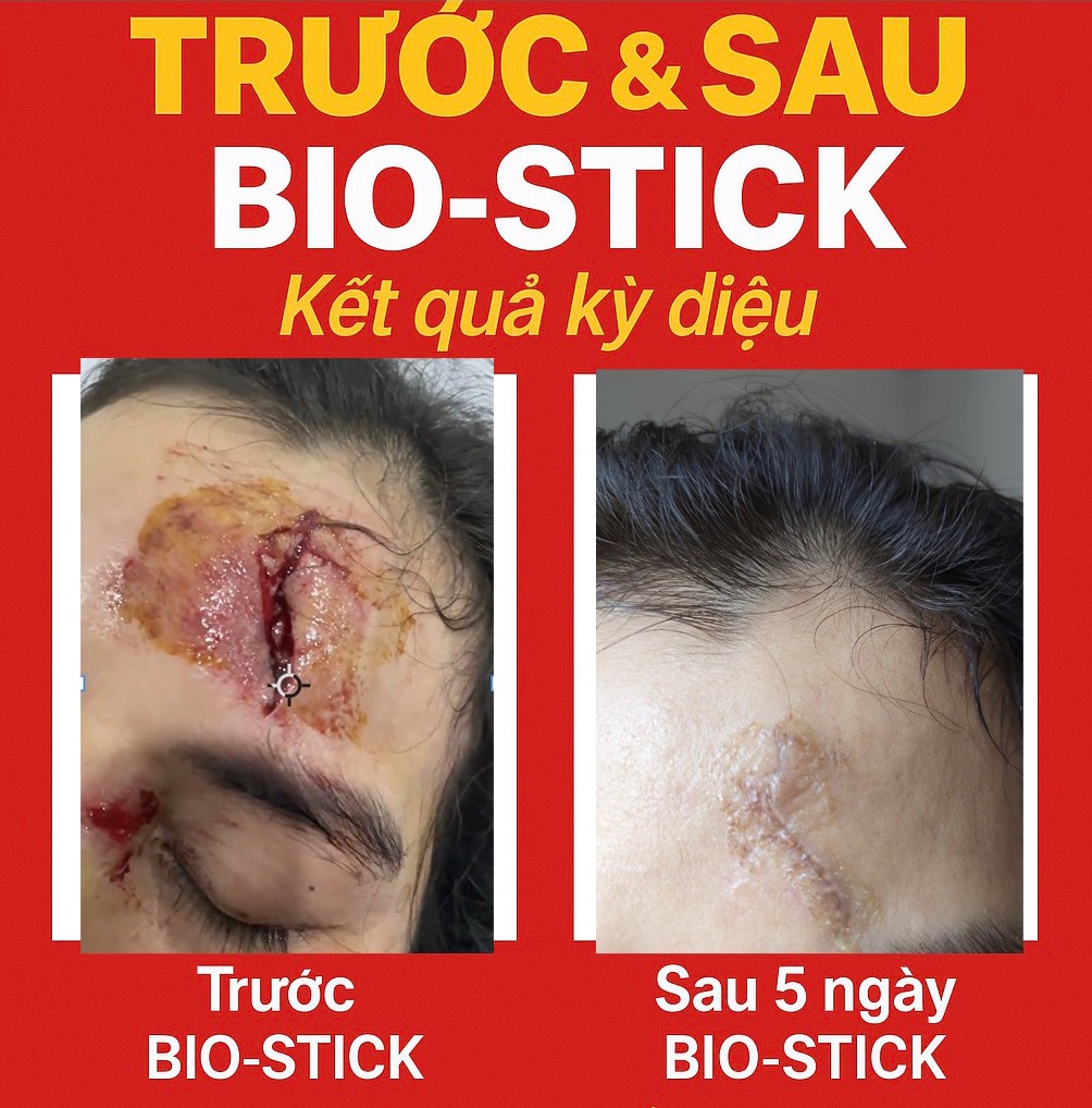 Kết quả Bio-Stick vết thương trán sau 5 ngày — Dr. Phan Sử, ptnsgiammo.vn