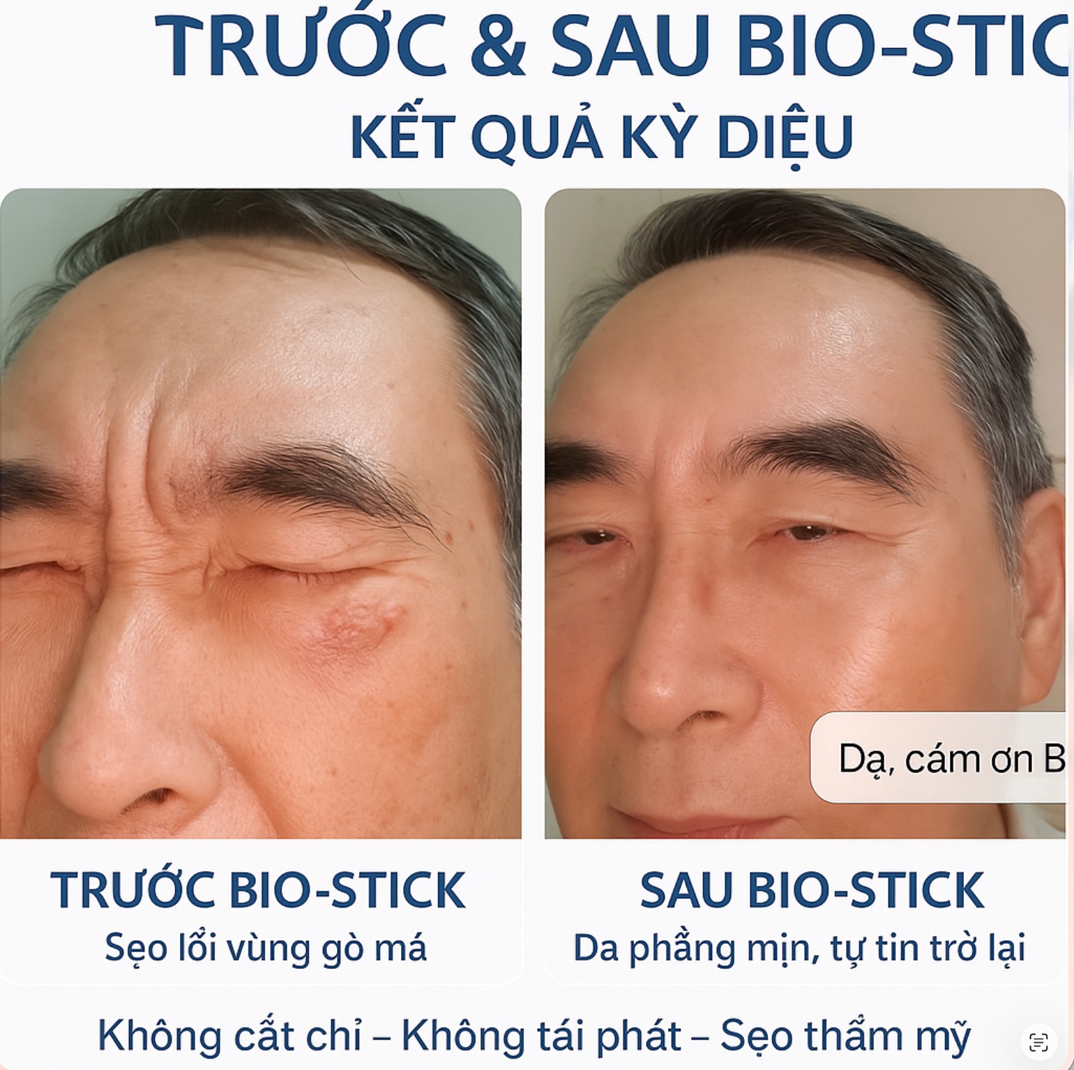 Bio-Stick xoá sẹo lồi gò má — tiến sĩ 72 tuổi, ptnsgiammo.vn