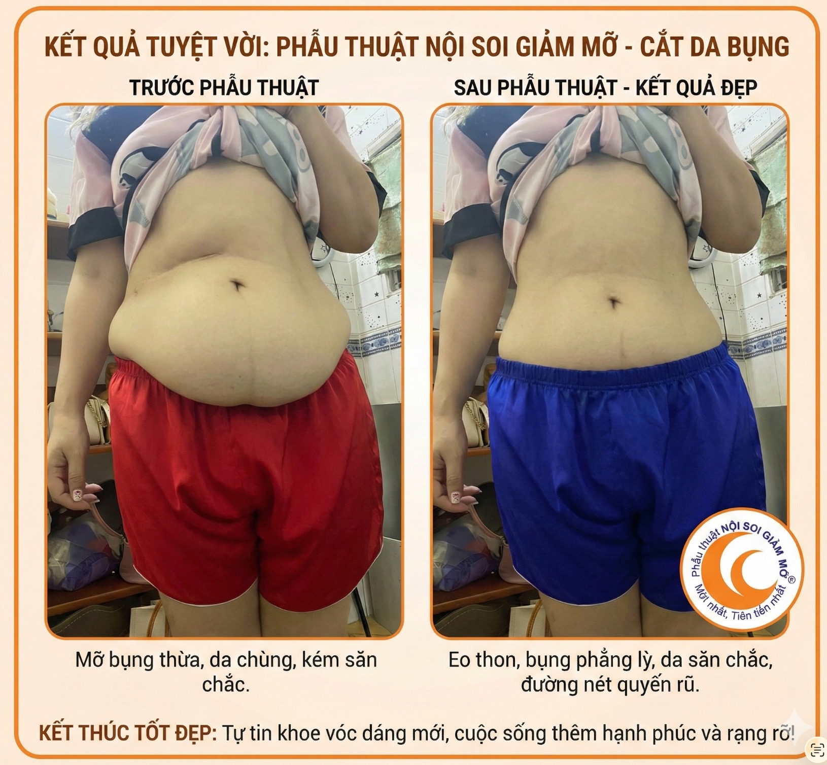 Kết quả PTNS Giảm Mỡ nội soi số 3 — tạo dáng eo bụng trước sau, ptnsgiammo.vn