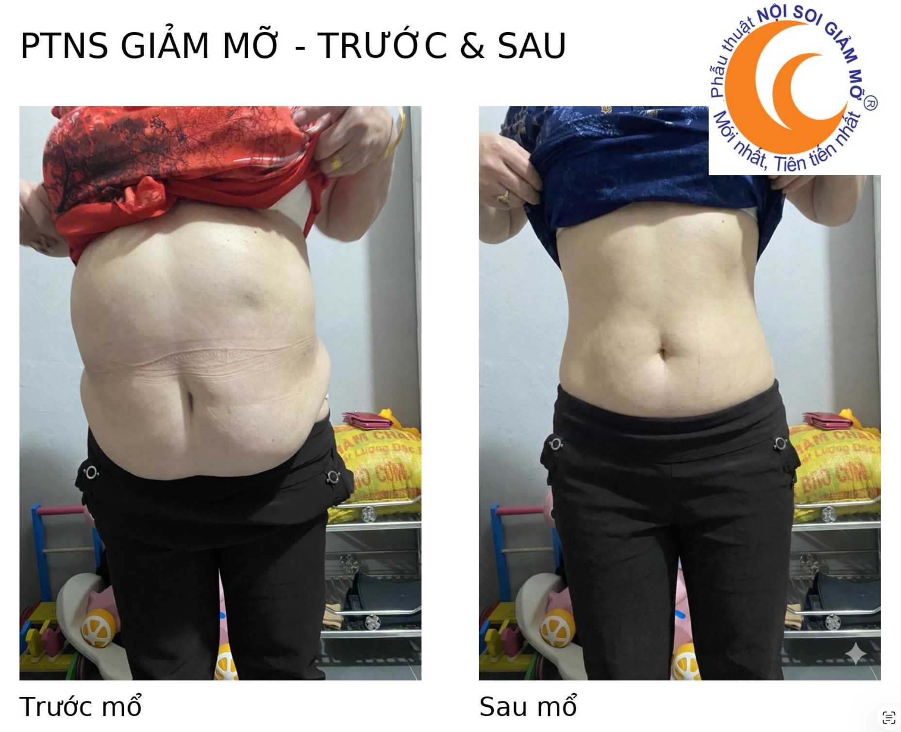 Kết quả PTNS Giảm Mỡ nội soi số 1 — trước và sau phẫu thuật, Dr. Phan Sử, ptnsgiammo.vn