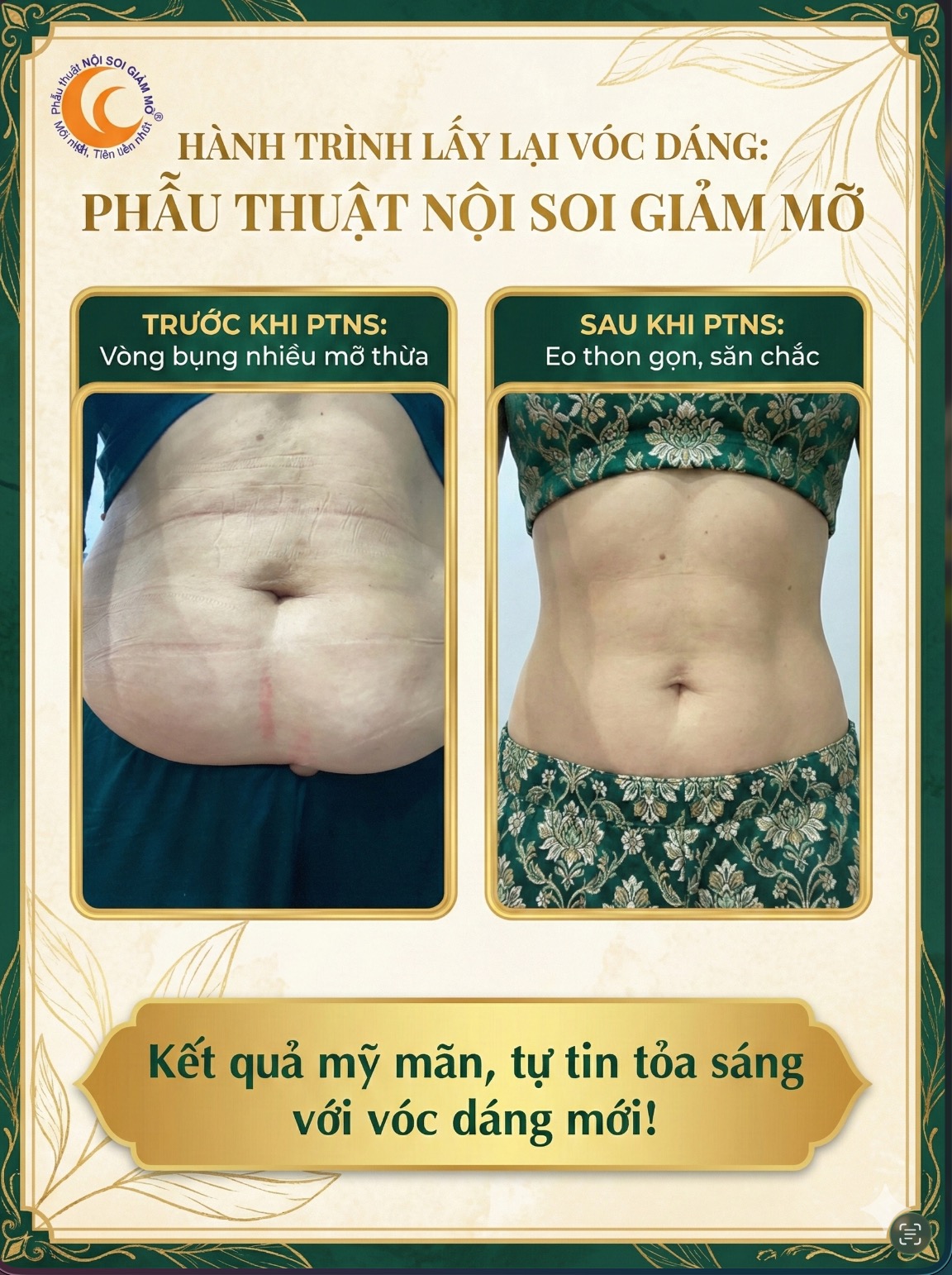 Kết quả PTNS Giảm Mỡ nội soi — chị Mai A., 38 tuổi, Quy Nhơn, khâu cơ bụng