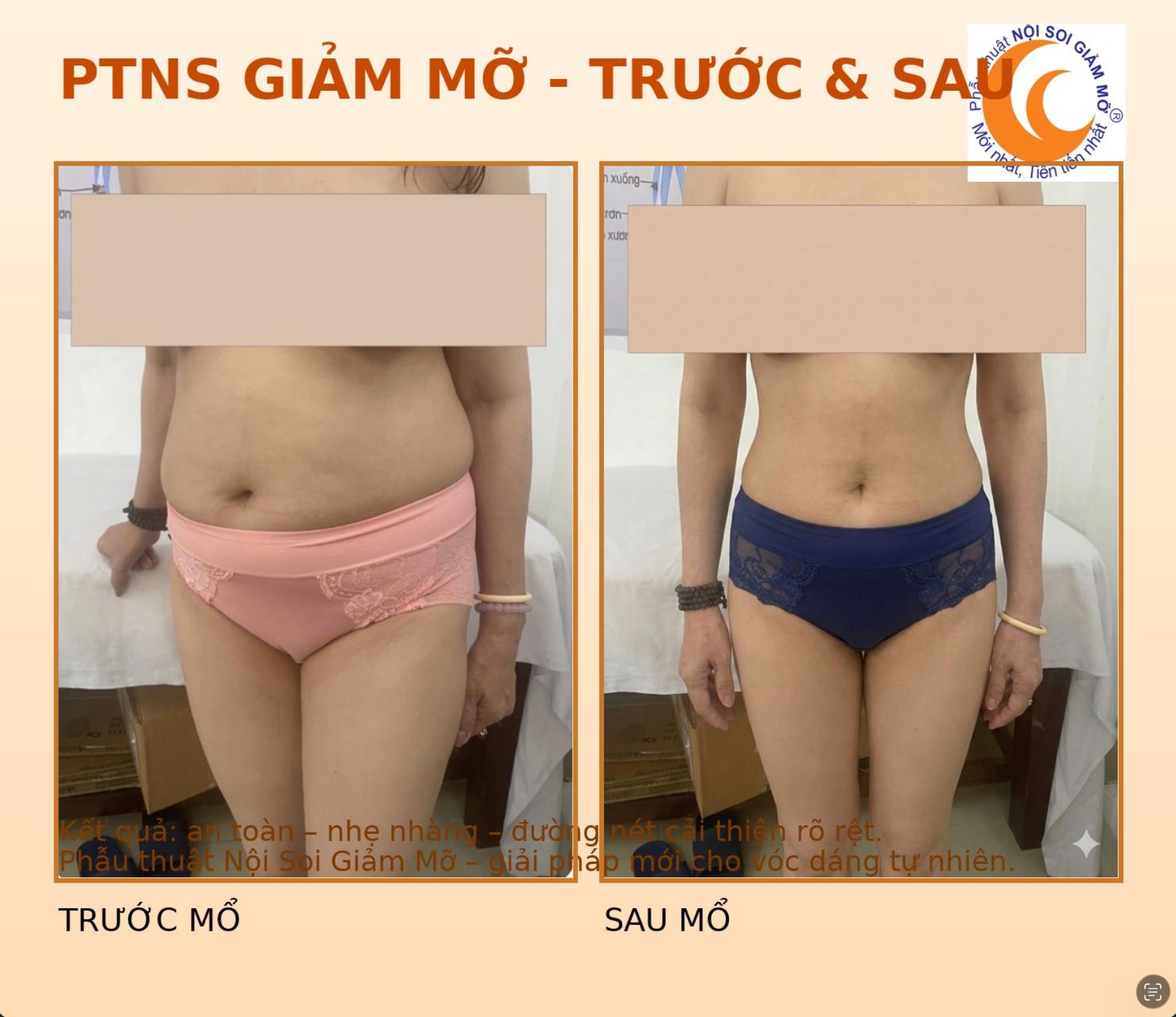 Kết quả PTNS Giảm Mỡ nội soi — chị Mai X., 55 tuổi, Việt kiều Canada