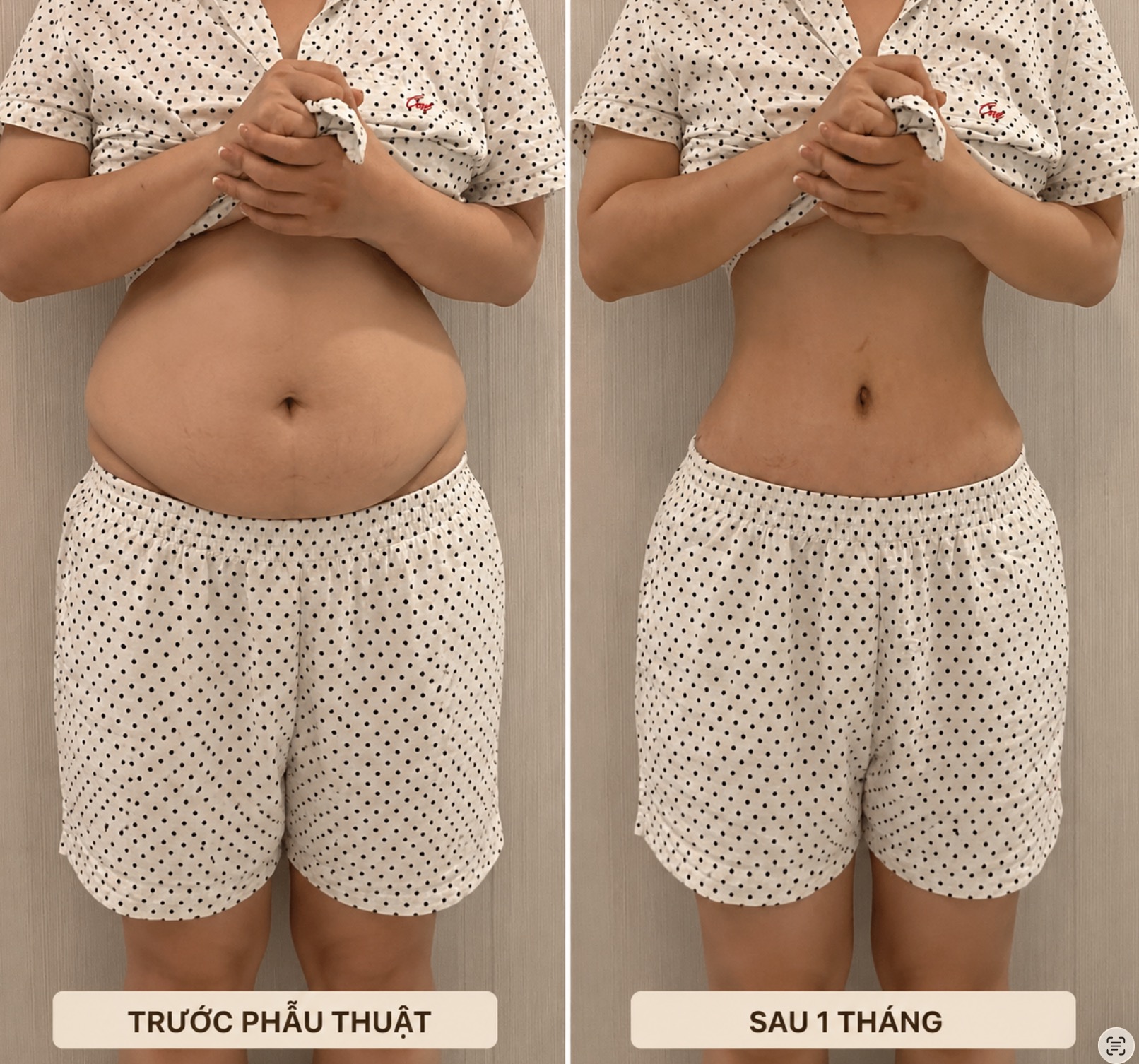 Kết quả PTNS Giảm Mỡ nội soi số 2 — hình thực tế bệnh nhân trước sau, Dr. Phan Sử